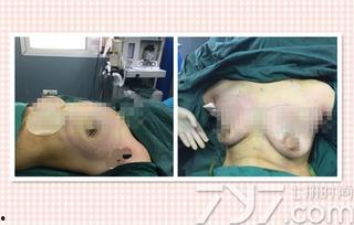 胸部照片真实,胸部影像解读揭秘